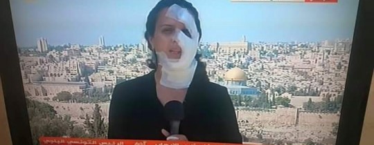 أصيبت المراسلة هناء محاميد خلال تغطيتها اعتداء الاحتلال على منزل شهيد القدس فادي علون