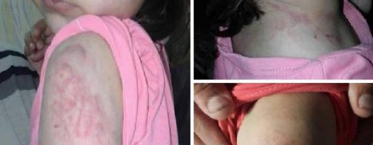 آثار الاعتداء على الطفلة