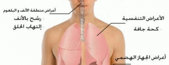 انفلونزا الخنازير